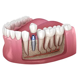 Illustration of single dental implant