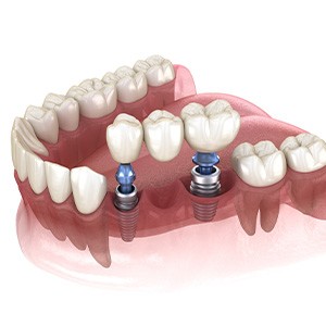 Illustration of implant bridge