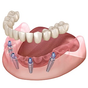 Illustration of implant denture