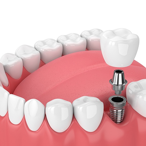 There are many benefits to dental implants