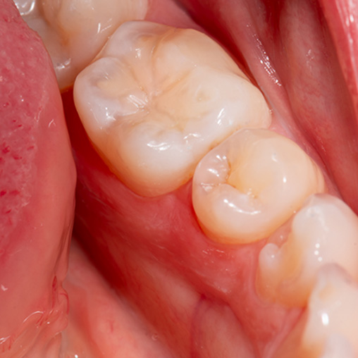 Close up of patients mouth while receiving tooth colored filling in New Brighton